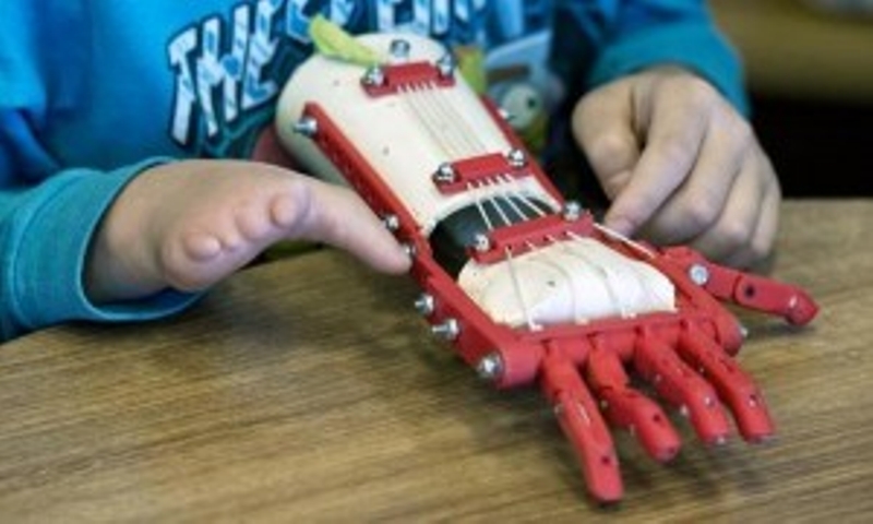 يد ثلاثية الأبعاد تساعد طفل بدون أصابع
