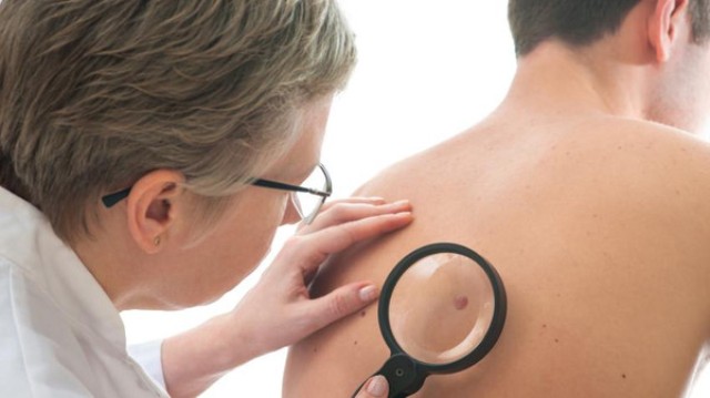 اكتشاف علاج ثوري لأخطر أنواع سرطان الجلد