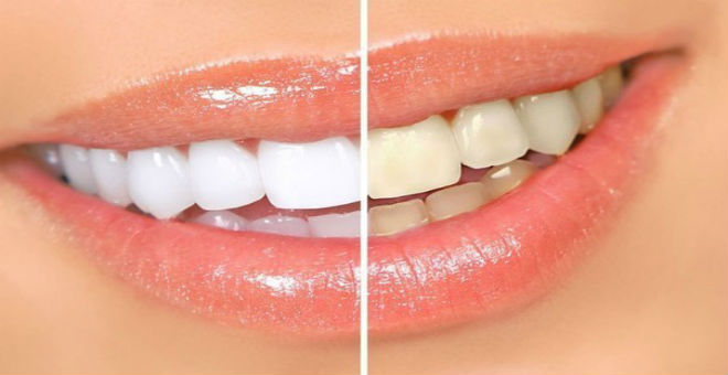 10 طرق لتبييض الاسنان في دقيقتين