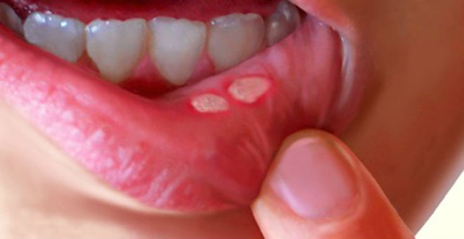 ودعي الألم بـ3 علاجات طبيعية للقضاء على تقرحات الفم
