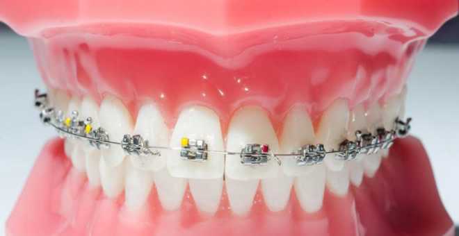 الكشف عن جهاز جديد يمكن من تقويم الأسنان في ظرف شهر ونصف فقط !!