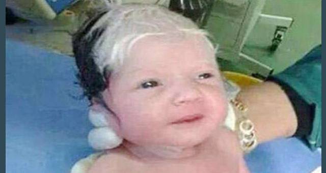 ولادة طفل سوري بشعر 
