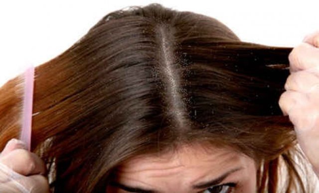 كيف تتخلصين من قشرة الشعر للأبد بالزعتر ؟