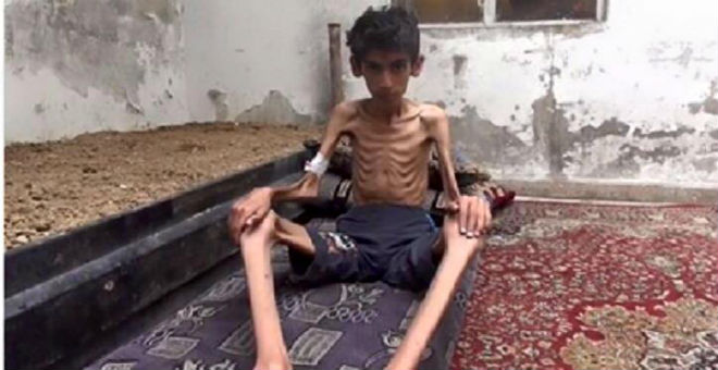 الموت البطيء يزحف على مضايا السورية بسبب نقص الغذاء
