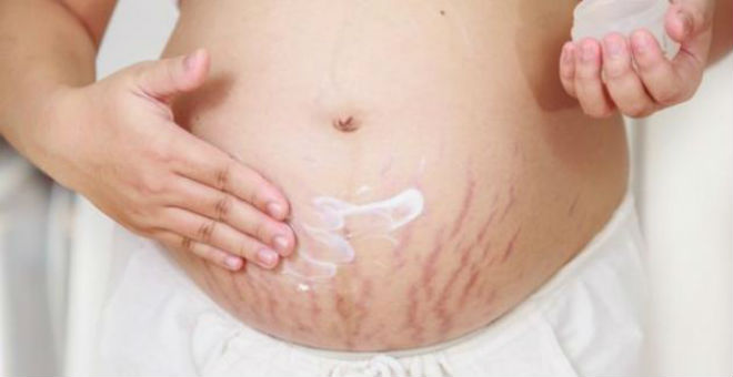 طريقة مذهلة للتخلص من تشققات جلد البطن بعد الولادة