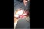 بالفيديو.. استخراج 12 فرشاة أسنان من معدة رجل