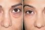 5 حيل للتخلص من الانتفاخات حول العينين