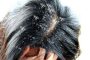 كيف تقضي على مشكلة قشرة الشعر في الشتاء؟