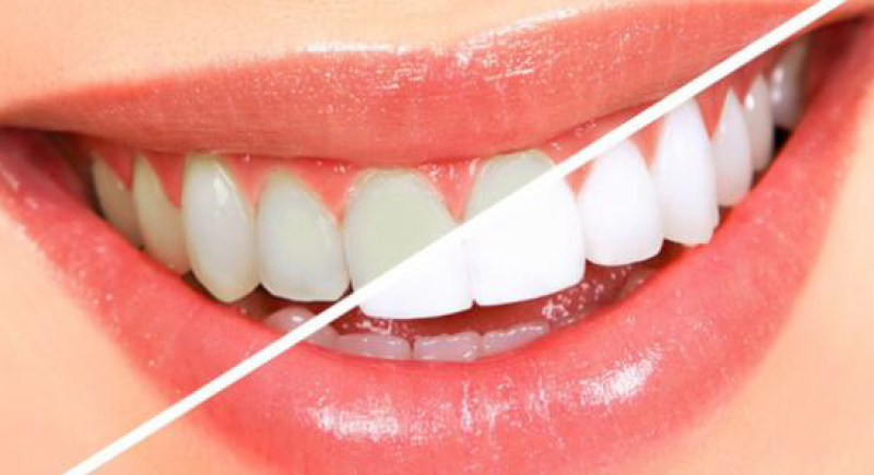 اكتشاف مادة بمفعول سحري لتبييض الاسنان بصورة آمنة