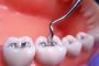 الحشو المعدني للأسنان ... خطر على الصحة!