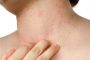 الإكزيما.. طرق علاج منزلية لأشهر الالتهابات الجلدية