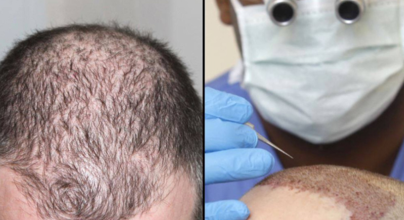 حادثة حيرت العلماء.. وفاة شخص في عملية زراعة شعر
