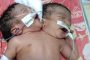 مصرية تضع مولودًا برأسين و5 أطراف