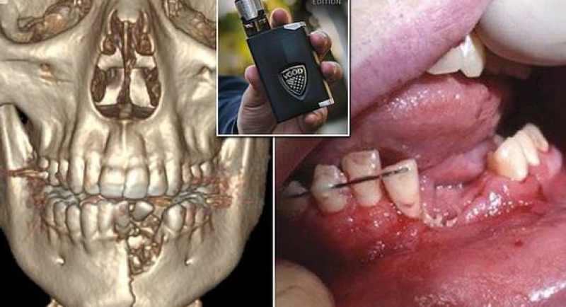 سيجارة إلكترونية تنفجر بفم مراهق وتسبب إصابات مرعبة