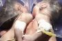 بالفيديو: حالة نادرة.. ولادة طفلتين بقلب واحد في الهند