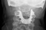 طبيب ينسى طاقم أسنان في حلق مريض مسن !