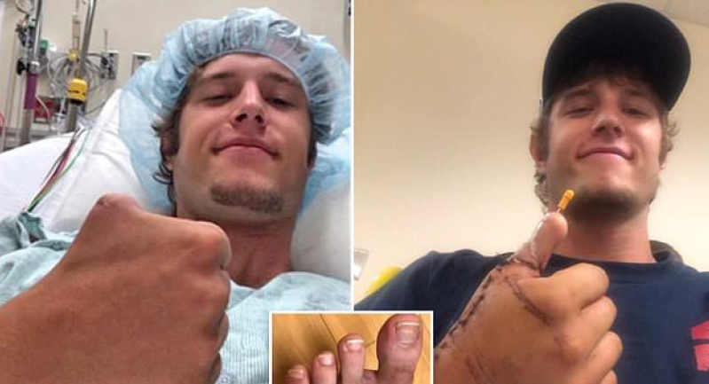 زرع إصبع قدم في كف أمريكي بعد قطع إبهامه بحادث