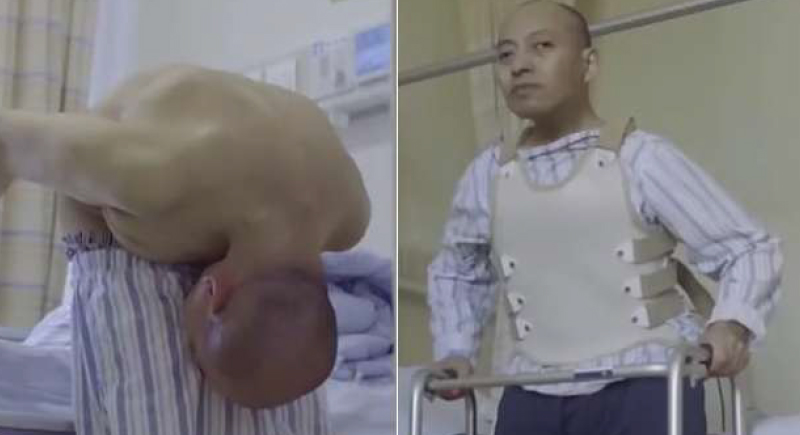 صور.. عملية جراحية تنقذ رجلا صينيا يعاني من مرض نادر بفقرات الظهر