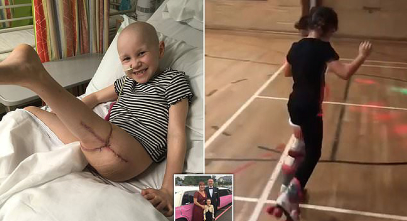 طفلة تلهم الملايين وتهزم السرطان بعد بتر ساقها وتثبيتها بشكل عكسي