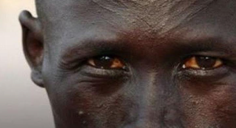 نزيف في الفم والأنف ثم الوفاة.. ظهور مرض غامض في أثيوبيا