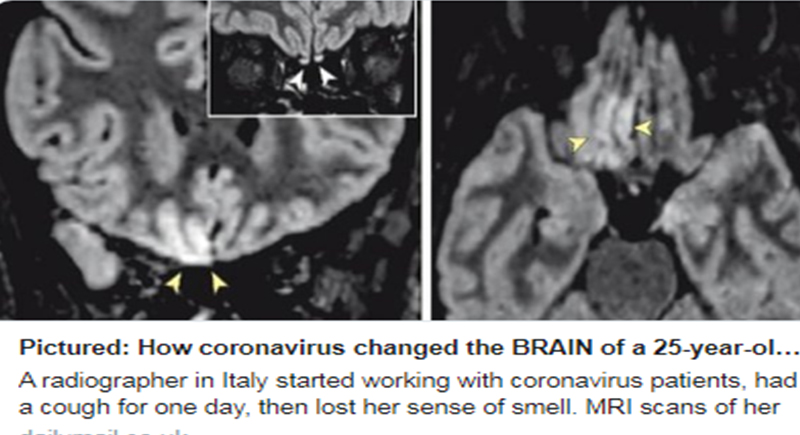 فيروس كورونا يغير دماغ مريضة عمرها 25 عاما