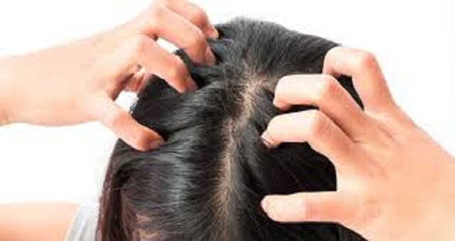 5 وصفات طبيعية تخلصك من قشرة الشعر نهائيا