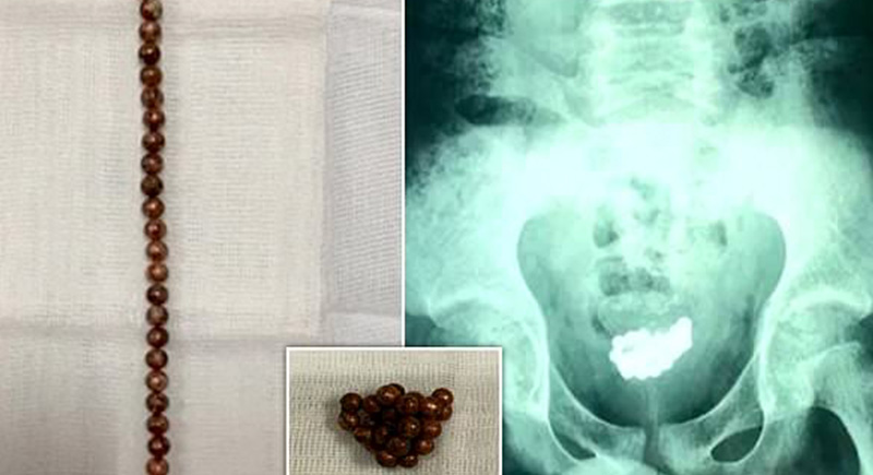 أطباء يستخرجون 190 حبة مغناطيس من معدة طفلة (فيديو)