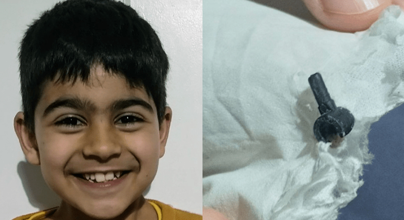 خروج قطعة ليجو من أنف طفل بعد عامين من فقدانها
