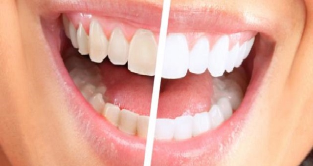 وصفة طبيعية لتبييض الأسنان