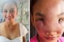 “مرض غريب”.. فتاة تصاب بالعمى بعد أن ضغطت على أنفها
