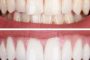 طرق طبيعية لإزالة جير الأسنان