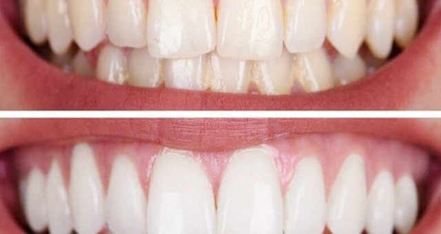 طرق طبيعية لإزالة جير الأسنان
