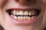البقع البنية على الأسنان.. هل من طريقة للتخلص منها؟