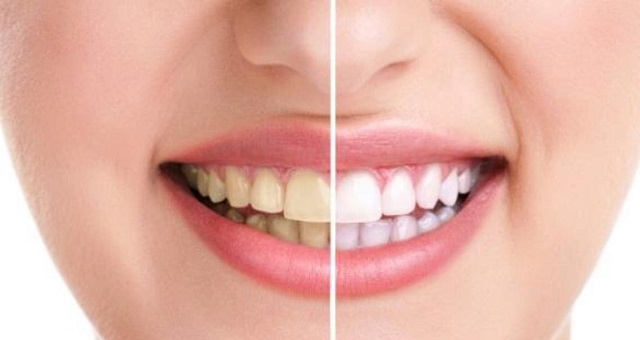 3 وصفات طبيعية لتبييض الأسنان