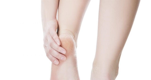 4 وصفات طبيعية لعلاج تشقق القدمين