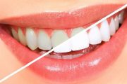 3 خلطات طبيعية لتبييض الأسنان في دقائق