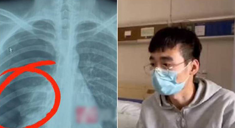 شاب صيني يتعرض لانفجار في الرئة لسبب غريب