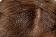 5 علاجات منزلية طبيعية للتخلص من قشرة الشعر