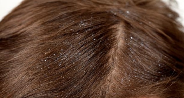 5 علاجات منزلية طبيعية للتخلص من قشرة الشعر