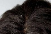 زيت جوز الهند للتخلص من قشرة الشعر