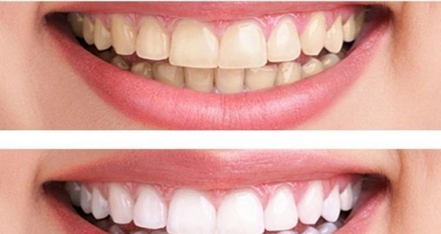 وصفات طبيعية للحصول على أسنان ناصعة البياض
